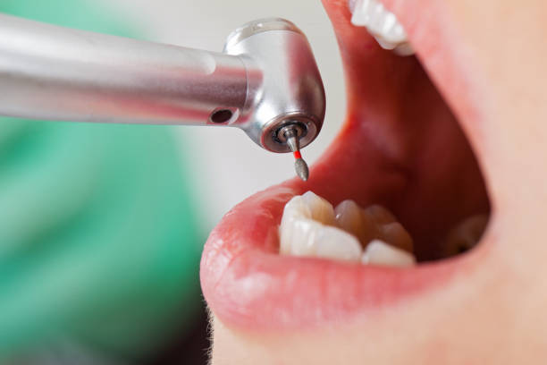 Best Emergency Root Canal Treatment in Killeen, TX